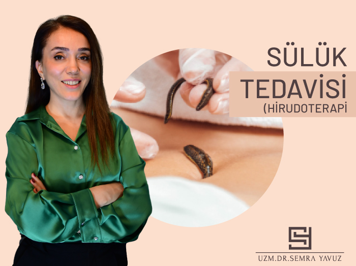 Sülük (Hirudoterapi) Tedavisi